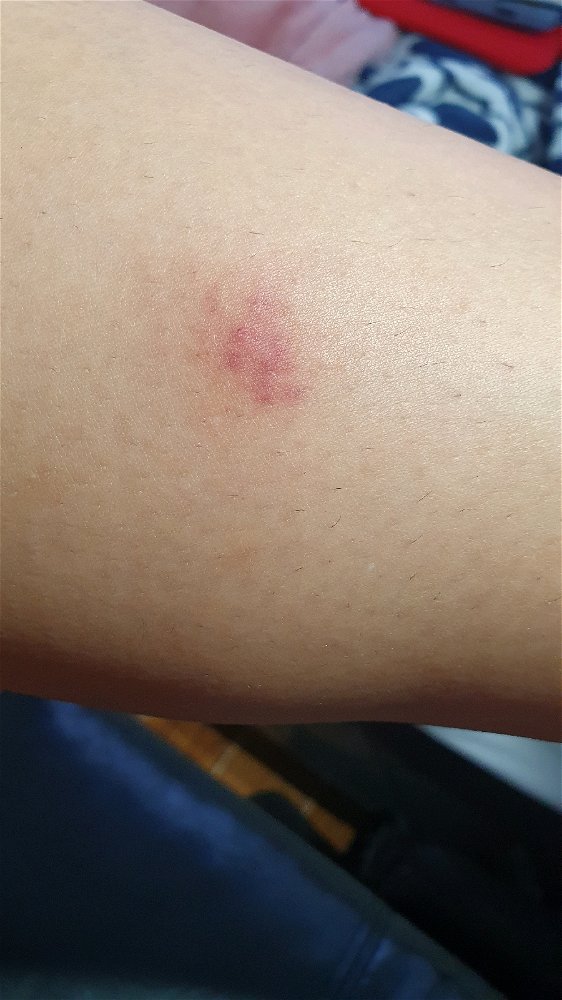 I always get bruising after a mosquito bite even though I don't scratch them. Weird and painful🤣. It's weird because it looks like hickey😵‍💫.