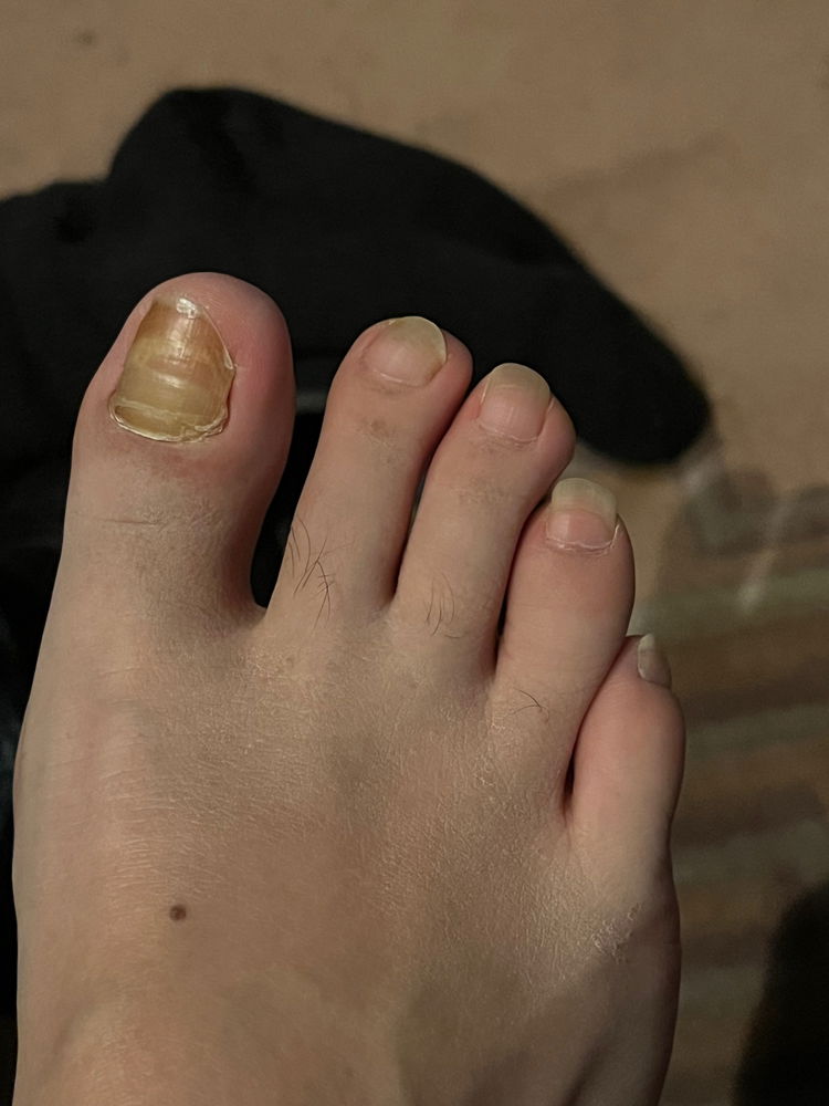 Okay foot inspection 🧐 time. Hmm 🤔 illegally long toenail length, with trauma on big toe from wearing compression socks and toe walking. Also traces of eczema on metatarsal