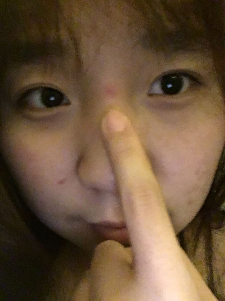 痘痘