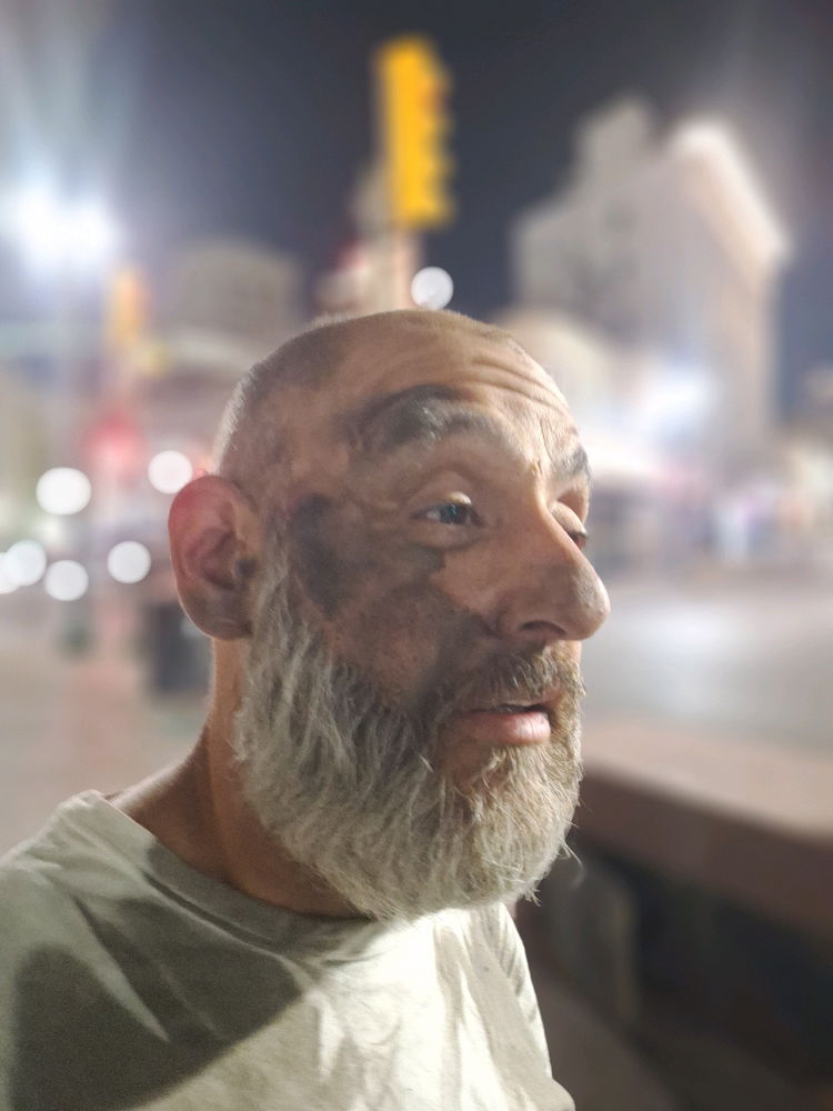 Three Cranial Fractures