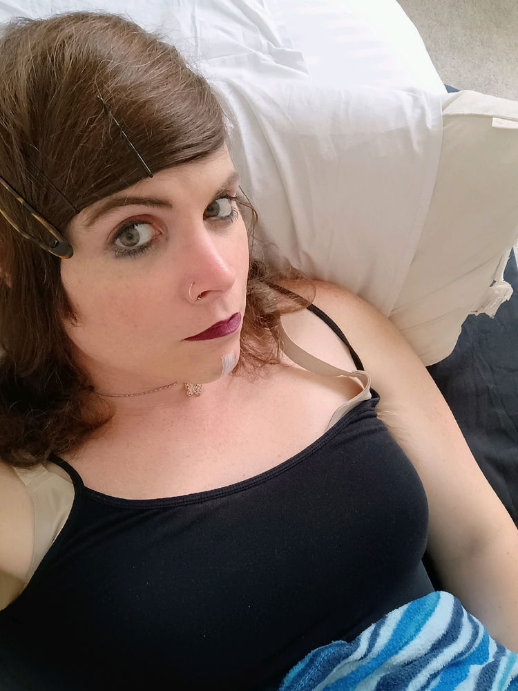 Had Feminization Facial Surgery Revision Today