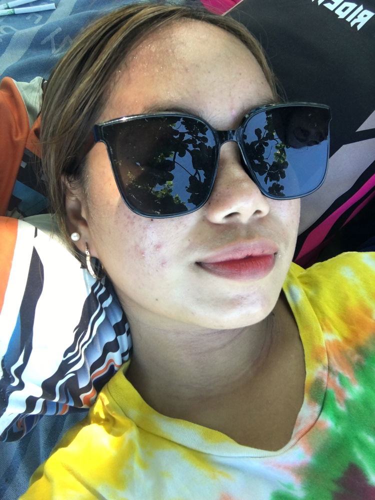 Pimples is not giving